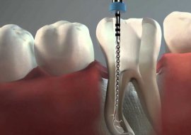 Endodoncia