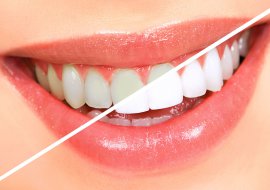Estética Dental